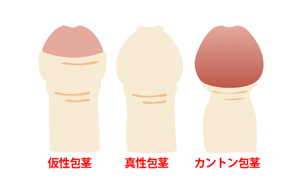 ３つの包茎