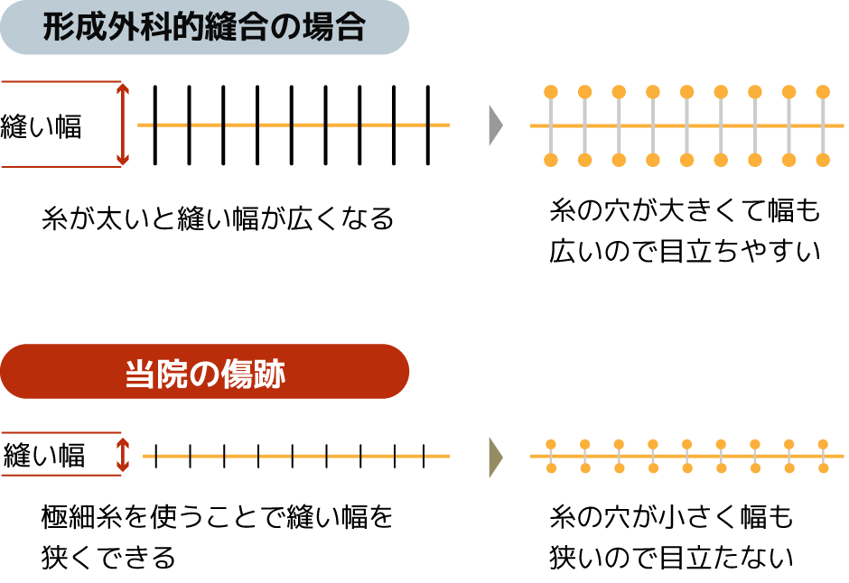 形成外科的縫合の場合と当院の傷跡