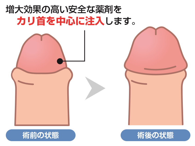 PLEMIUMヒアルロン酸注入
