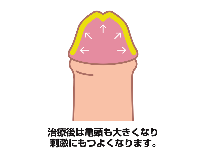 PLEMIUMヒアルロン酸注入